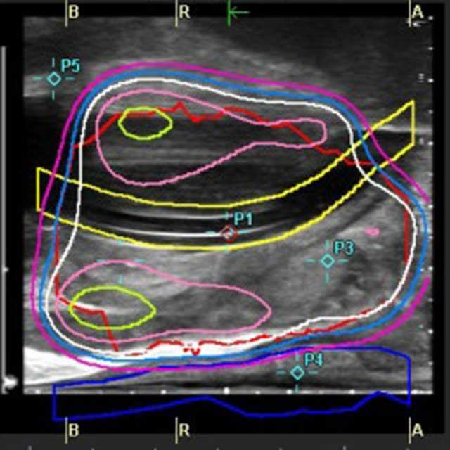 Digital visualization of radiation doze planning for high-dose-rate (HDR) prostate brachytherapy
