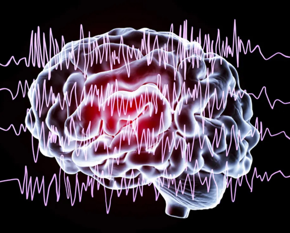 epilepsy brain waves