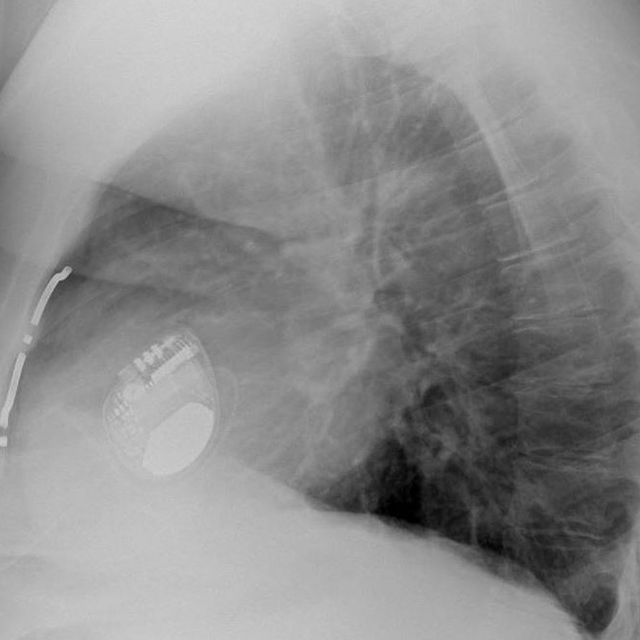 X-Ray of Lung