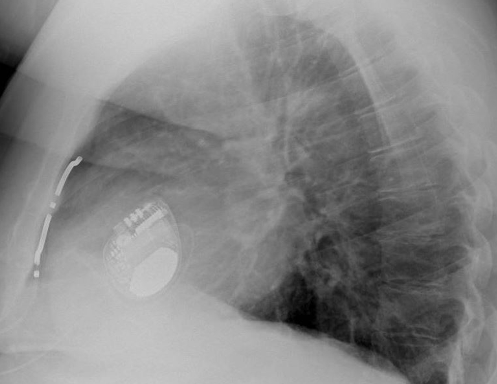 X-Ray of Lung