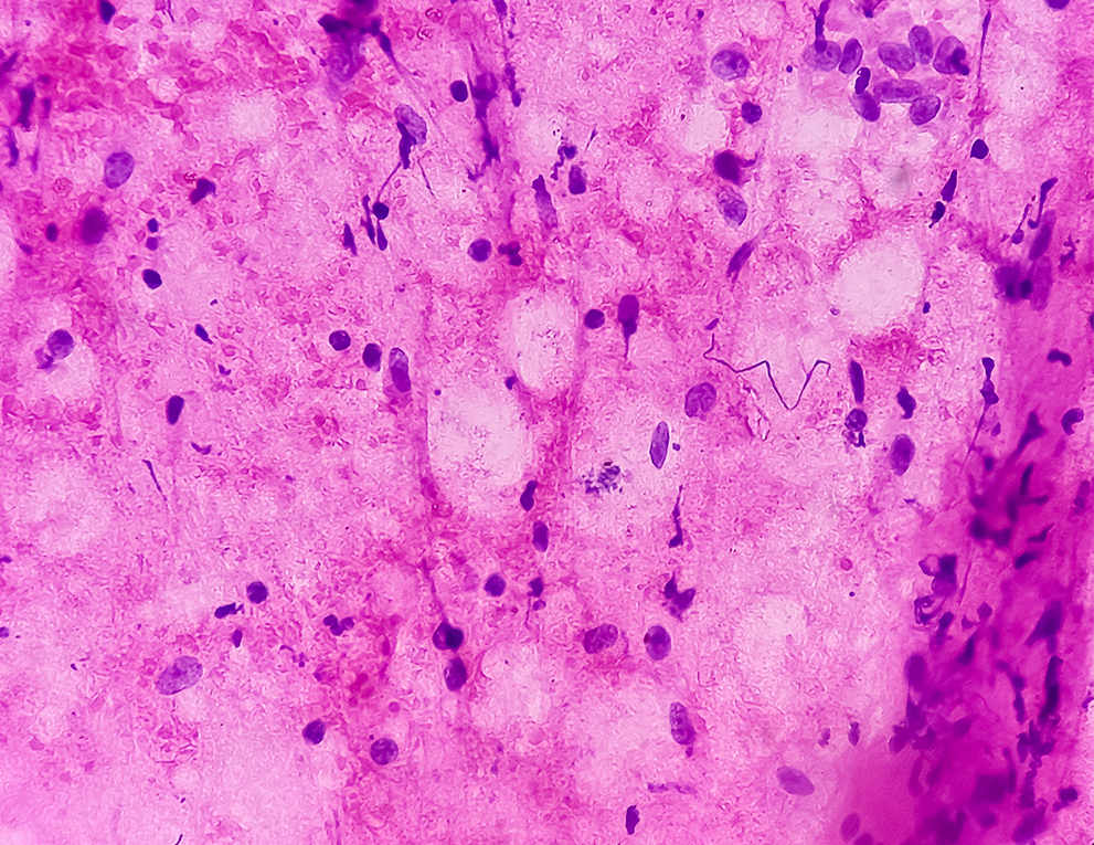 A microscopic image show spindle shaped cells with wavy nuclei