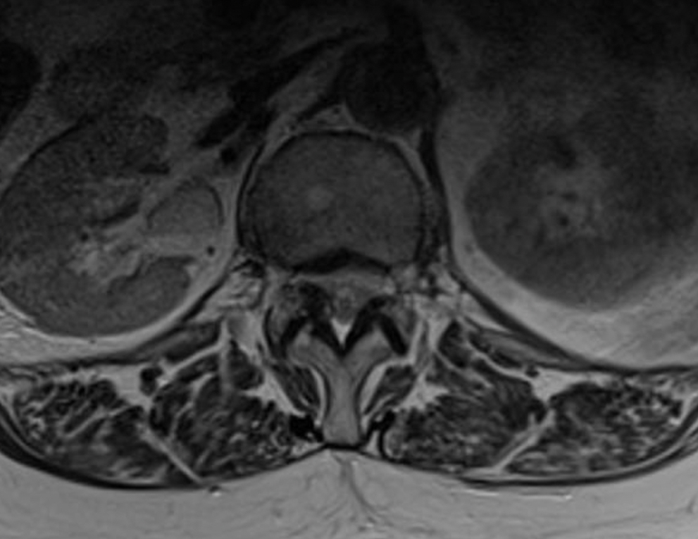 MRI image shows an axial section of a lumbar vertebra