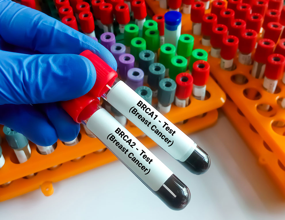 Abnormal BRCA2 Gene and Aggressive Prostate Cancer