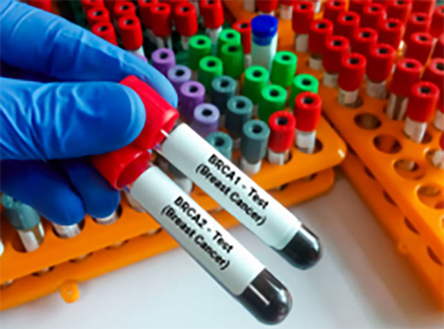 Abnormal BRCA2 Gene and Aggressive Prostate Cancer
