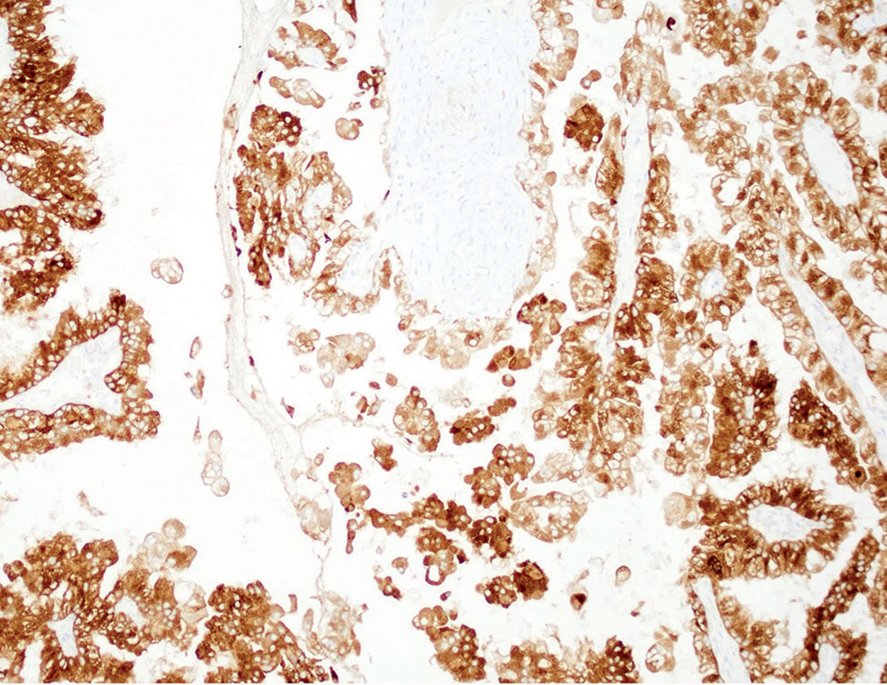 “pT3a” Stage in Kidney Cancer