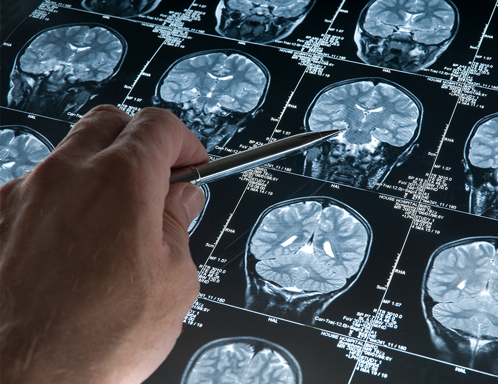 A hand holding a pencil points to a part of the brain on an MRI