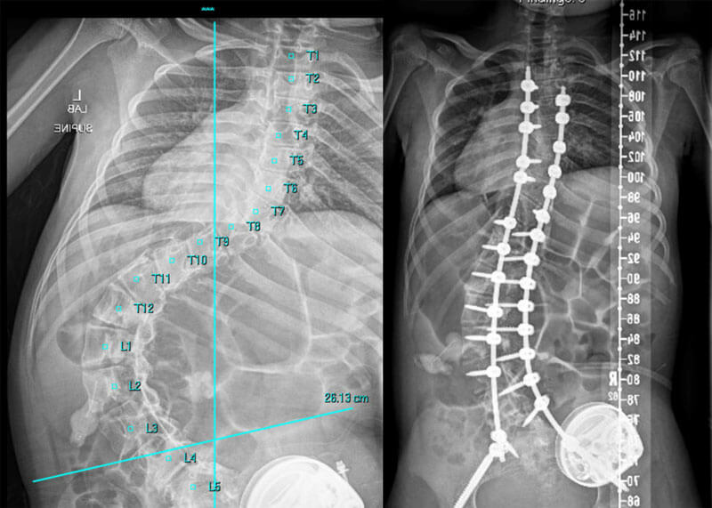Pediatric Spine Program Provides Comprehensive, Multidisciplinary Care ...