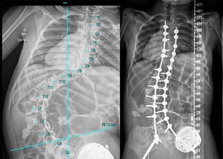 X-ray images of spinal curvature from complex scoliosis