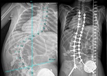 X-ray images of spinal curvature from complex scoliosis