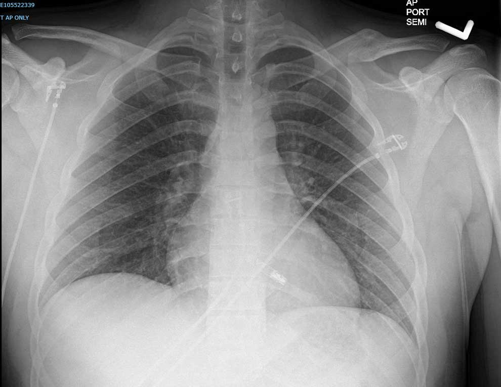Screenshot of a chest x-ray containing a leadless pacemaker