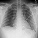 Screenshot of a chest x-ray containing a leadless pacemaker