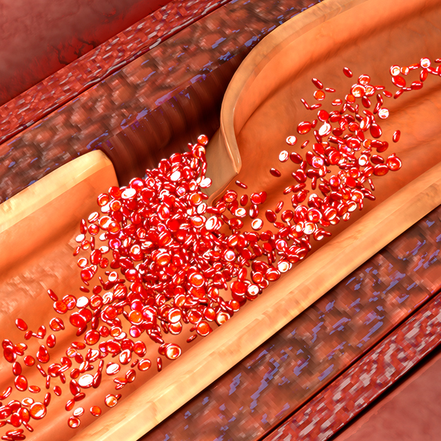 Medical illustration of coronary artery dissection
