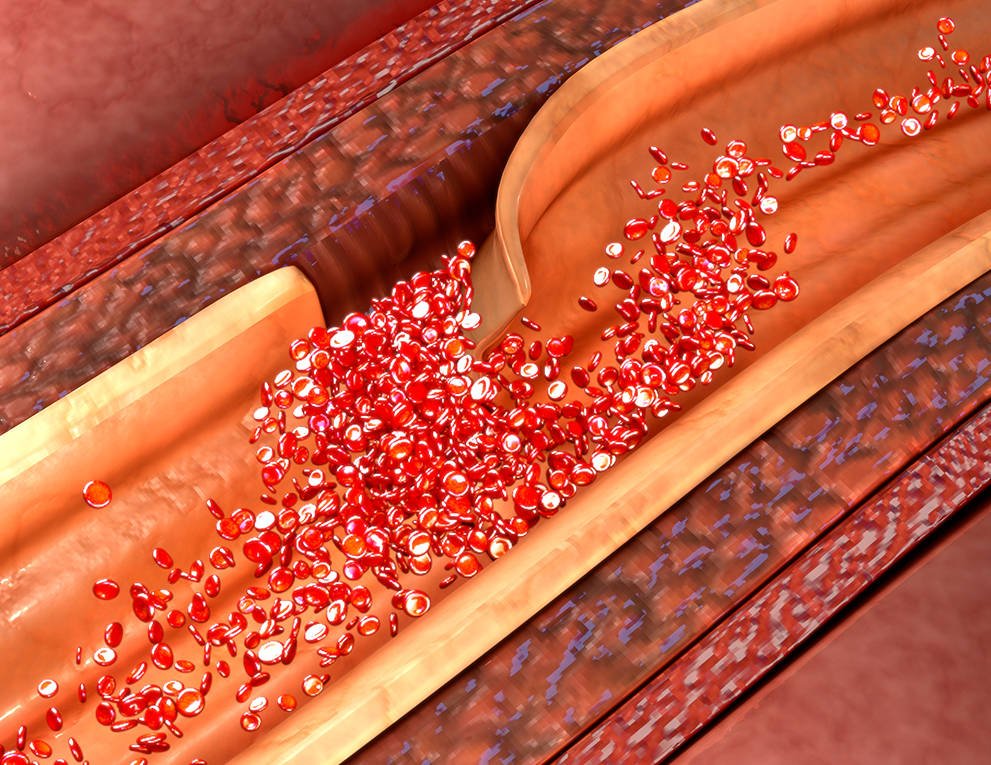 Medical illustration of coronary artery dissection