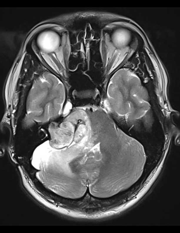 MRI brain scan showing a white tumor in the lower central area, highlighting surrounding tissues and eyes. Detailed grayscale imaging.