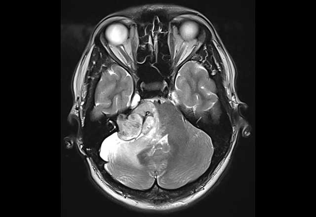 MRI brain scan showing a white tumor in the lower central area, highlighting surrounding tissues and eyes. Detailed grayscale imaging.