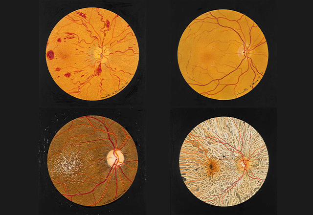 Photos of eye illustration