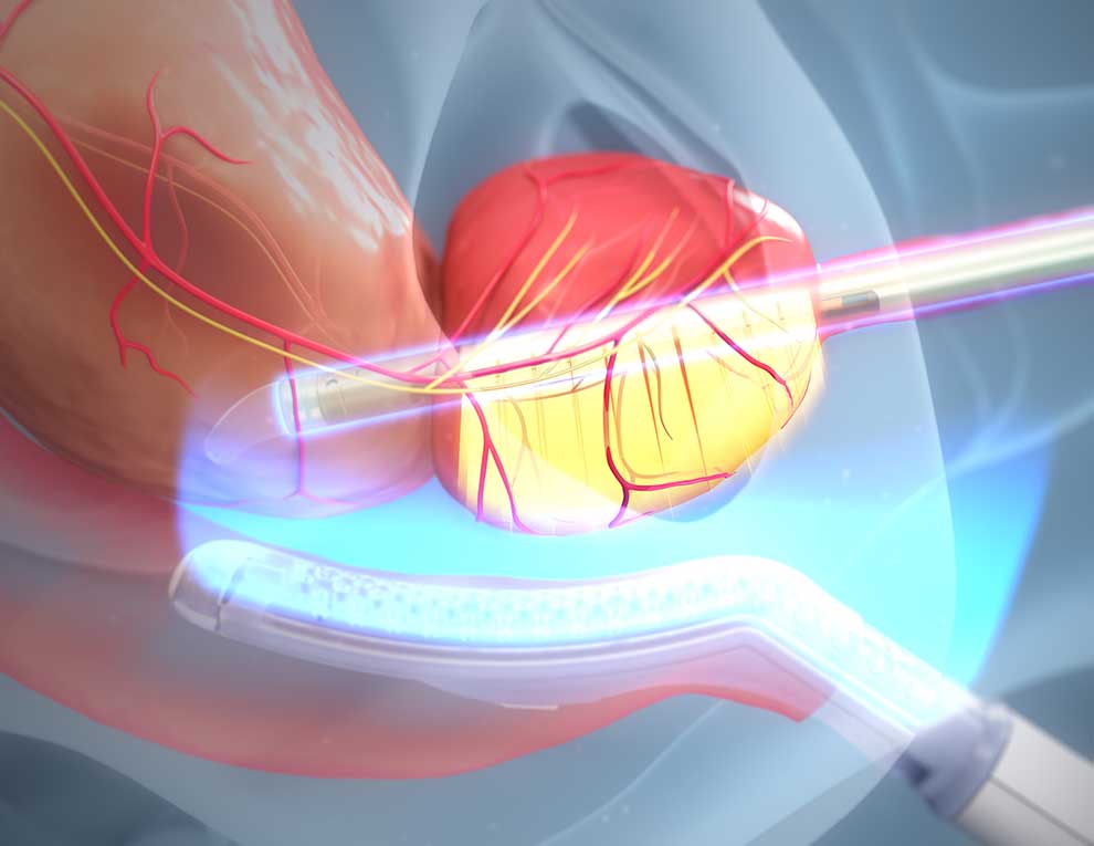 Digital illustration of a MRI-guided transurethral ultrasound ablation (TULSA), showing the tools, bladder and urethra.