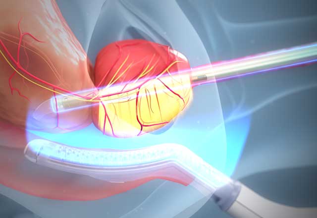 Digital illustration of a MRI-guided transurethral ultrasound ablation (TULSA), showing the tools, bladder and urethra.
