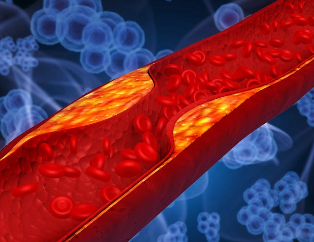 Clogged Coronary Artery