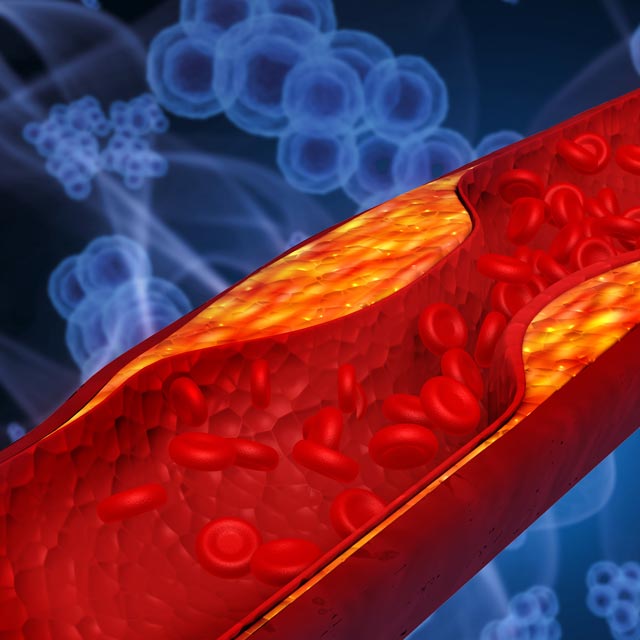 Clogged coronary artery