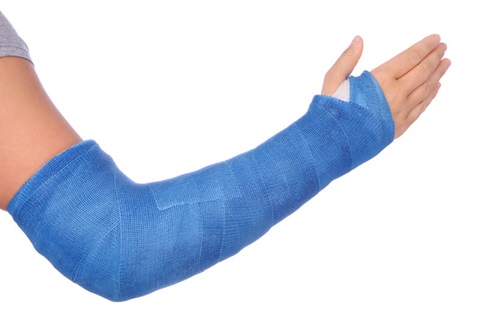 an arm in a cast up to the hand