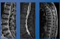 Three views of the spine MRI