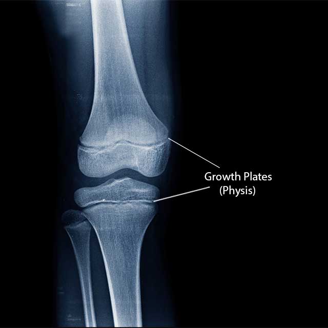 X-ray showing the knee joint connecting the tibia and fibia with the growth plates labeled on the image