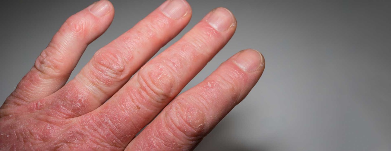 Close up of a person's hand with psoriasis