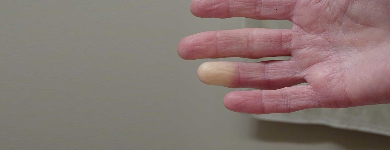 Hand with pale fingertip