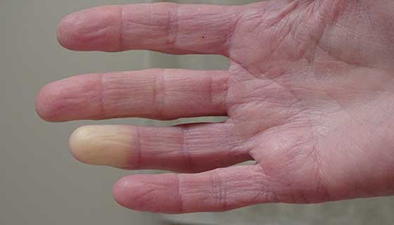 Hand with pale fingertip. 