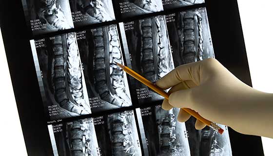 Healthcare provider pointing to a x-ray of a patient's spine.