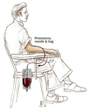 Sketch drawing of man with phlebotomy needle and bag in arm