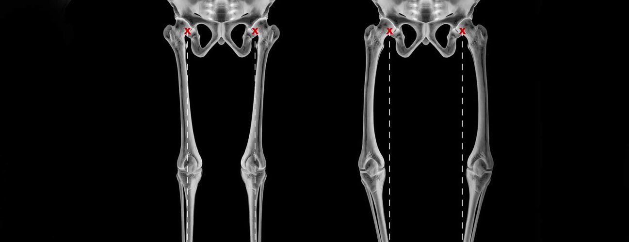 X-rays showing bow legs.