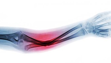 X-ray of broken arm.