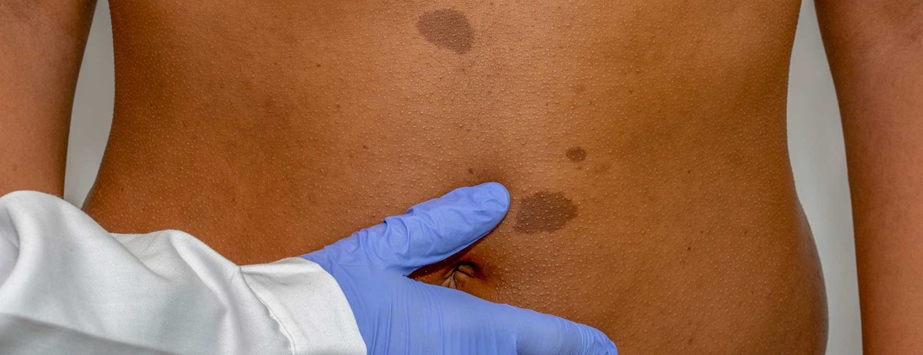Person with a cafe-au-lait birthmark on stomach