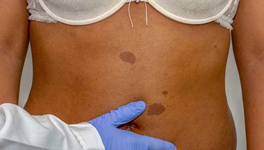 Neurofibromatoses