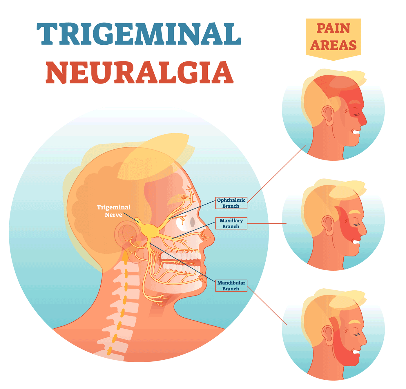 Diagram of the three different branches of the trigeminal nerve: the ophthalmic branch runs near the eye and leads to pain across the top half of the face and forehead; the maxillary branch runs across the nose and causes pain up cheeks and toward the temple; the mandibular branch starts near the ear and causes pain  down the jaw.