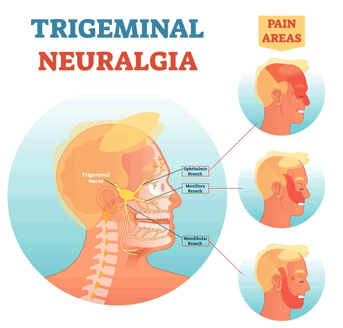 Trigeminal Neuralgia Treatment