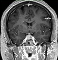 a pituitary tumor visible on an MRI