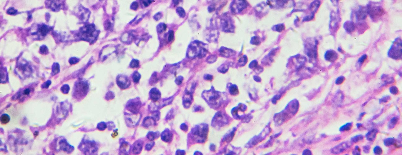 astrocytoma cells viewed under microscope