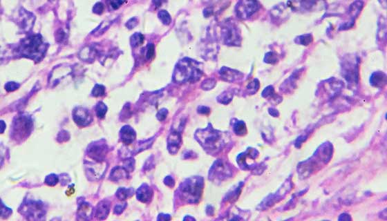 Glioblastoma Multiforme (GBM): Advancing Treatment for a Dangerous ...