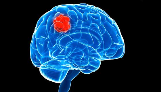 Brain Tumors in Children 8 Warning Signs You Should Know ...