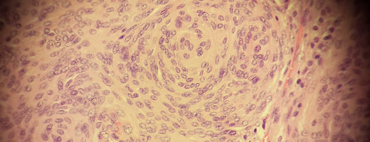 Meningioma cells seen under a microscope