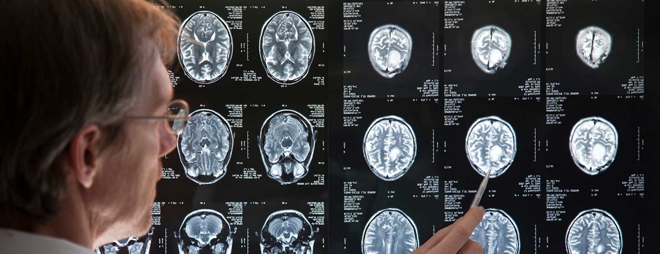 Doctor pointing to a series of brain x-rays