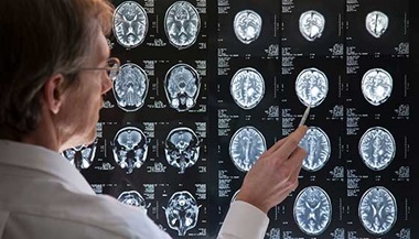 Doctor pointing to a series of brain x-rays