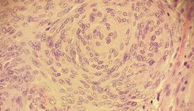 Meningioma cells seen under the microscope