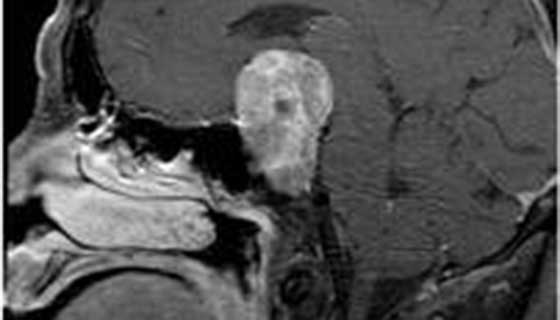 MRI scan of a pituitary adenoma