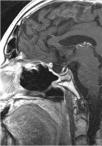MRI scan of the pituitary gland after surgery to remove an adenoma. 