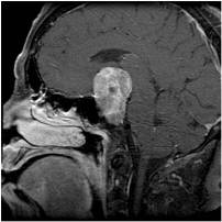 Large pituitary adenoma before surgery seen in MRI