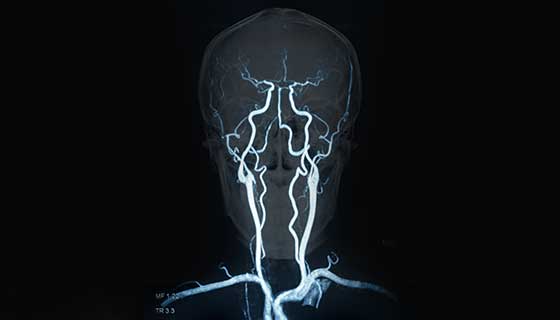 x-ray of brain arteries